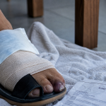 Entorse orteil : orteil gonflé après choc, avec bandage et compresse froide