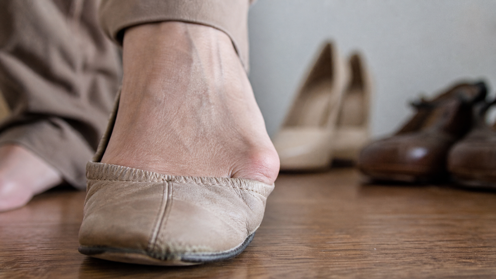 Oignon pied : bosse du gros orteil dans une chaussure serrée